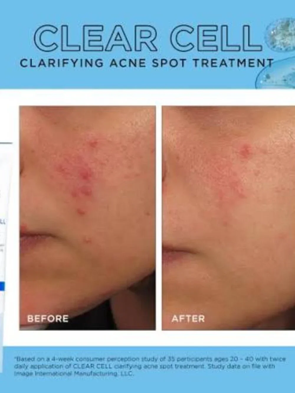 Image Skincare this acne